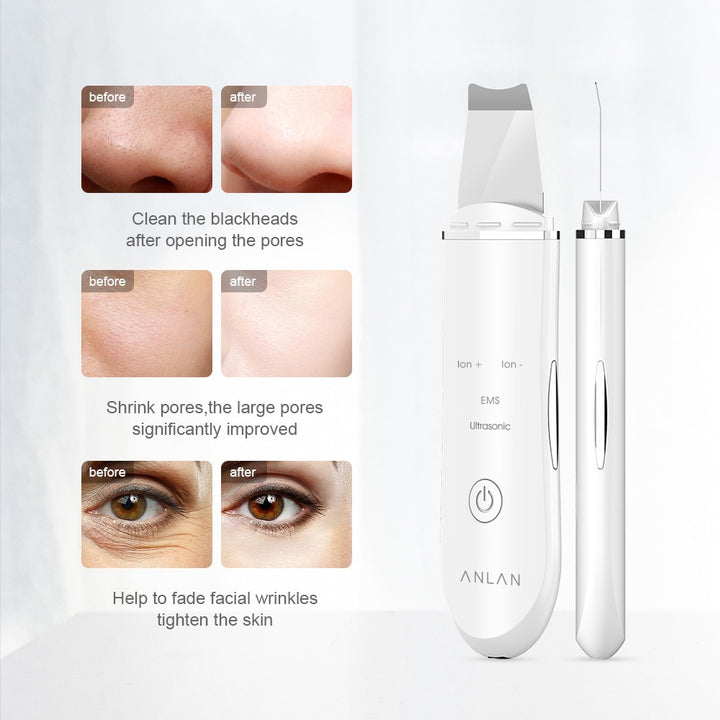 Facial Rejuvenator: The Ultrasonic Skin Lift Machine